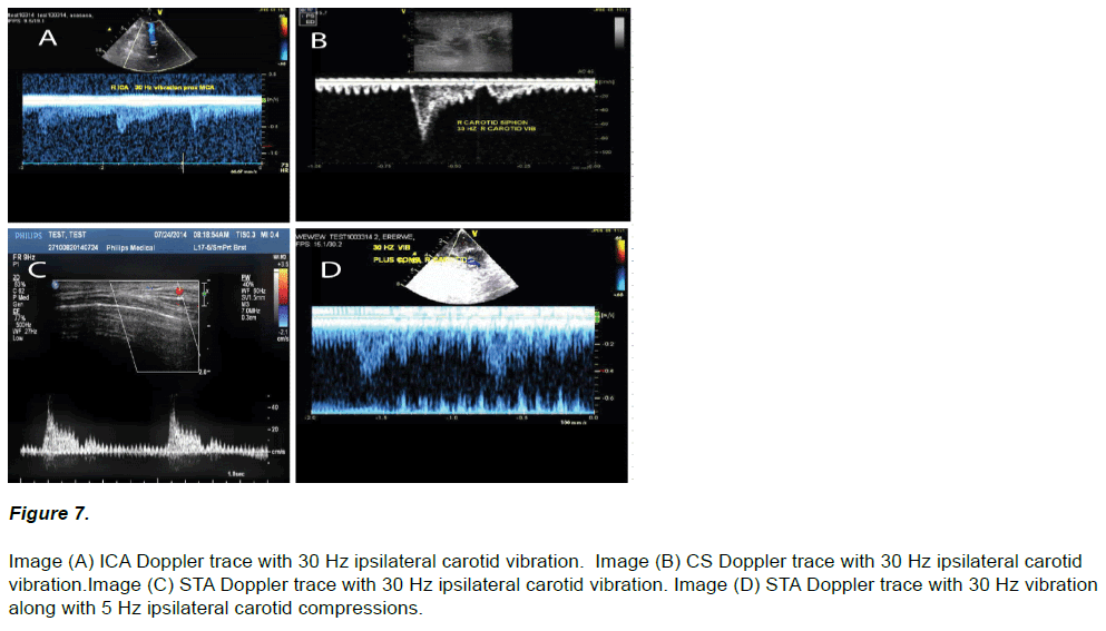 experimental-stroke-translational-medicine-vibration-Image