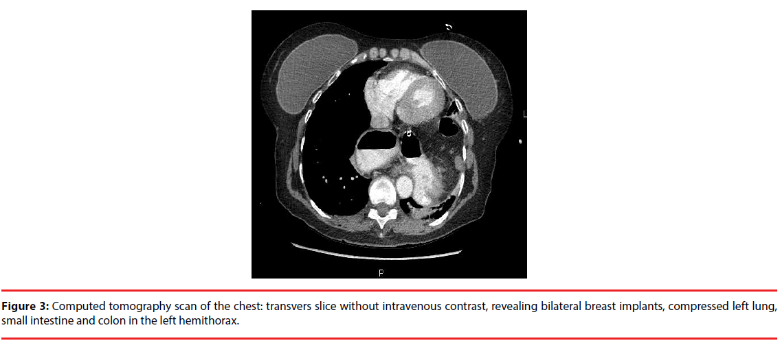 ijocs-bilateral-breast