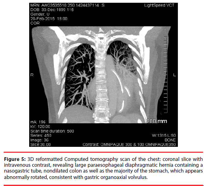 ijocs-diaphragmatic-hernia