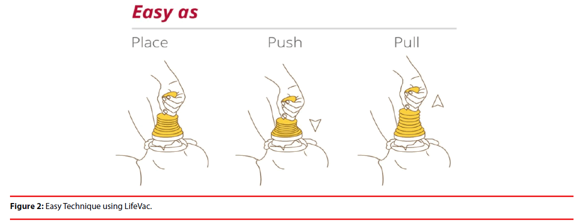 ijocs-hip-ratio-Easy-Technique