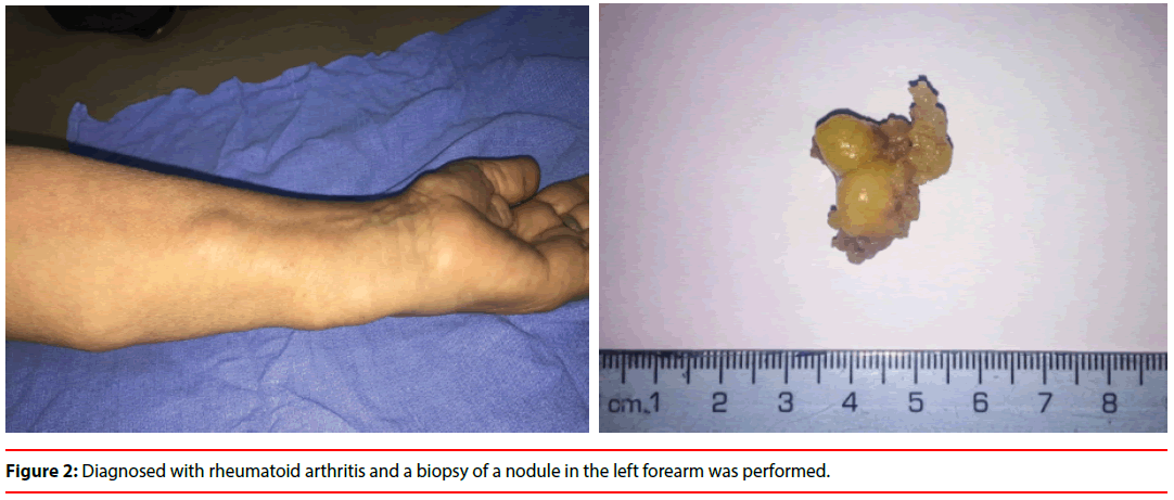 ijocs-left-forearm