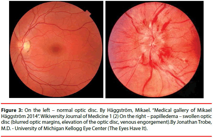 ijocs-margins-optic-disc