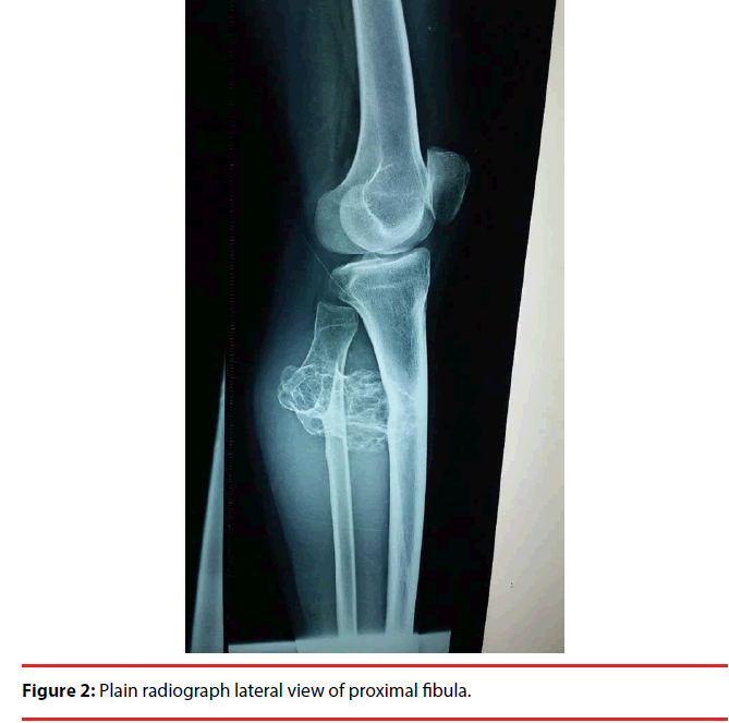 ijocs-radiograph-fibula