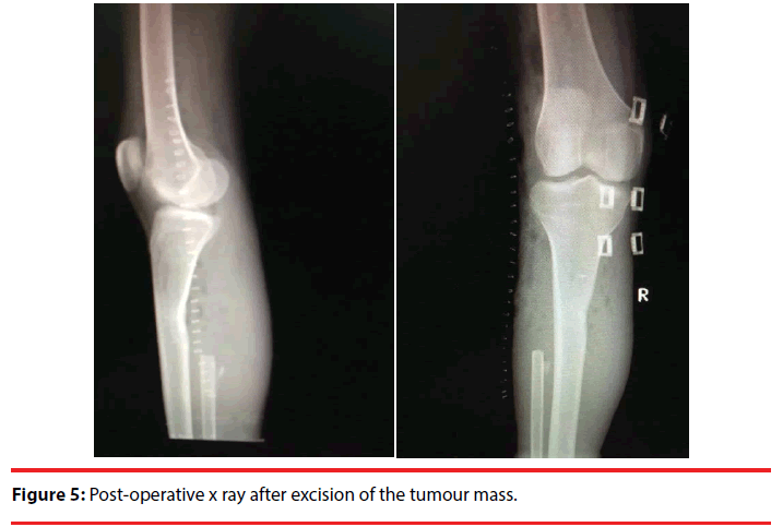 ijocs-tumour-mass