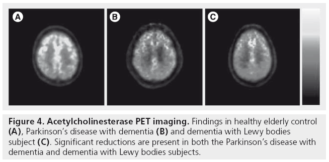 imaging-in-medicine-Acetylcholinesterase