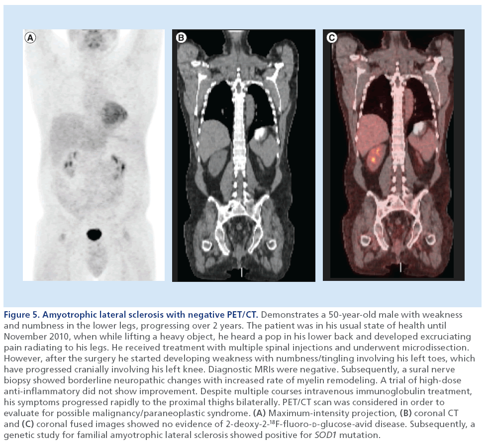imaging-in-medicine-Amyotrophic