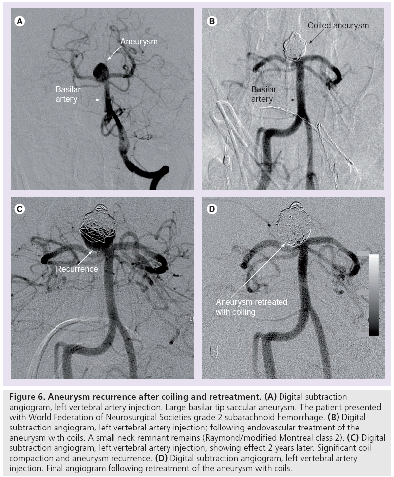 imaging-in-medicine-Aneurysm-recurrence