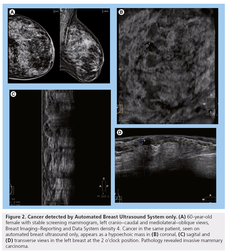 imaging-in-medicine-Automated-Breast