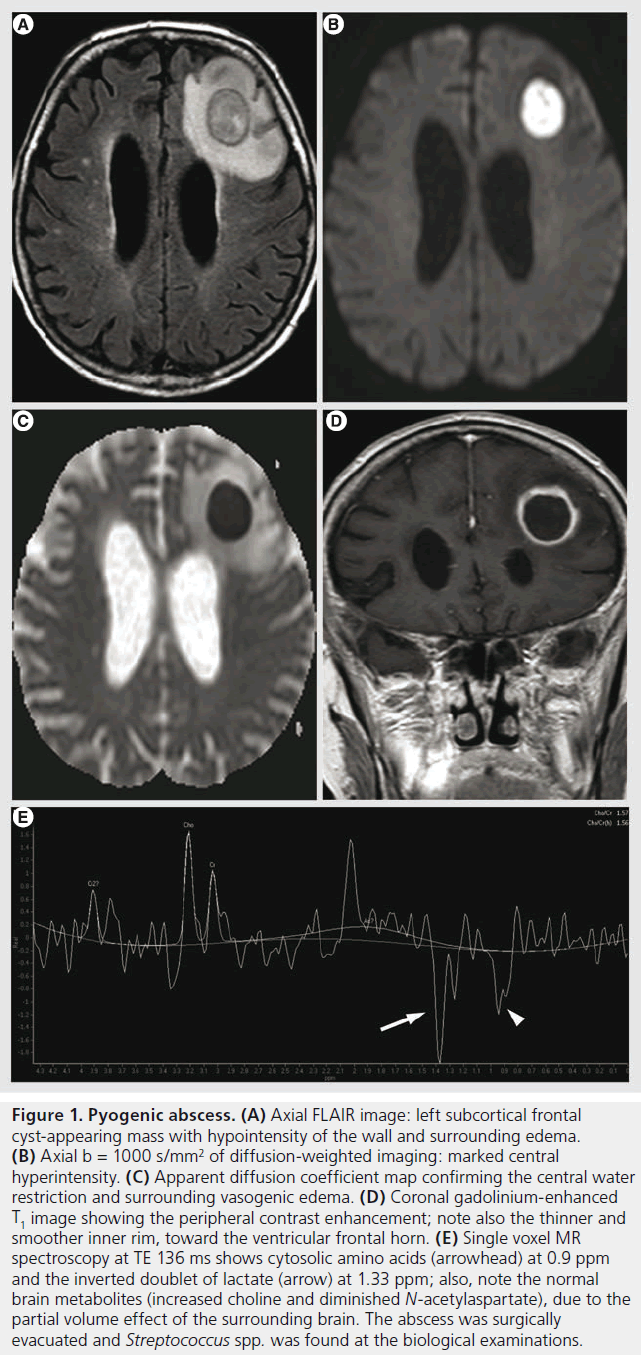 imaging-in-medicine-Axial-FLAIR
