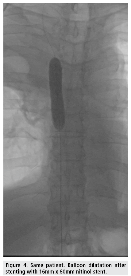 imaging-in-medicine-Balloon-dilatation