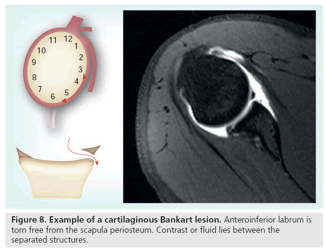 imaging-in-medicine-Bankart-lesion