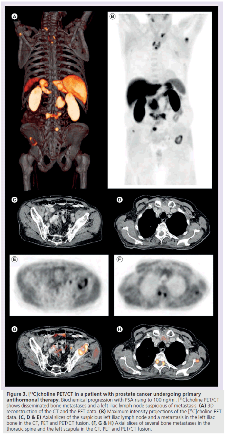 imaging-in-medicine-Biochemical-progression