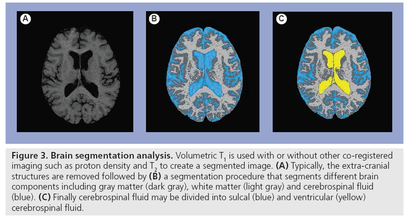 imaging-in-medicine-Brain-segmentation