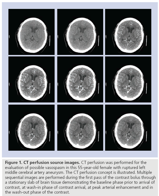 imaging-in-medicine-CT-perfusion