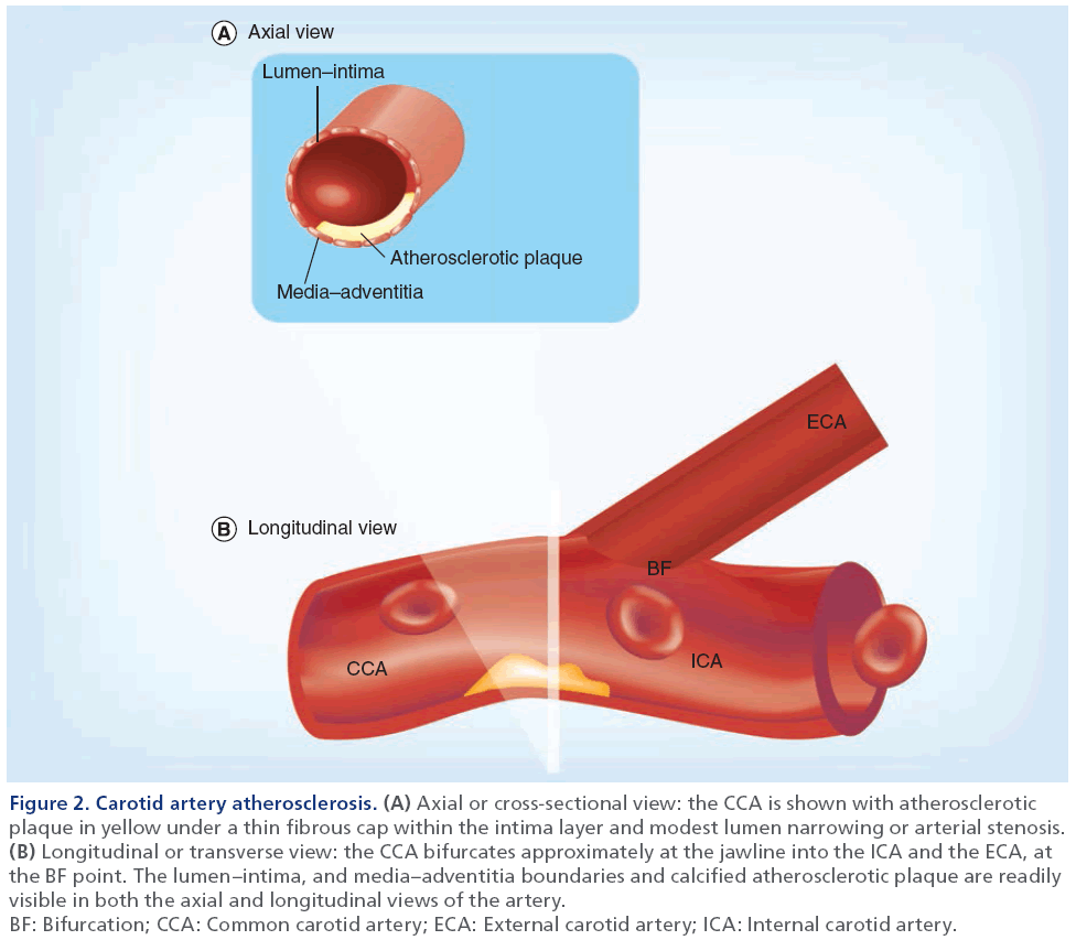 imaging-in-medicine-Carotid-artery