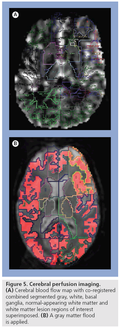 imaging-in-medicine-Cerebral-perfusion