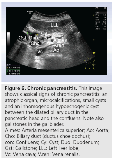 imaging-in-medicine-Chronic-pancreatitis
