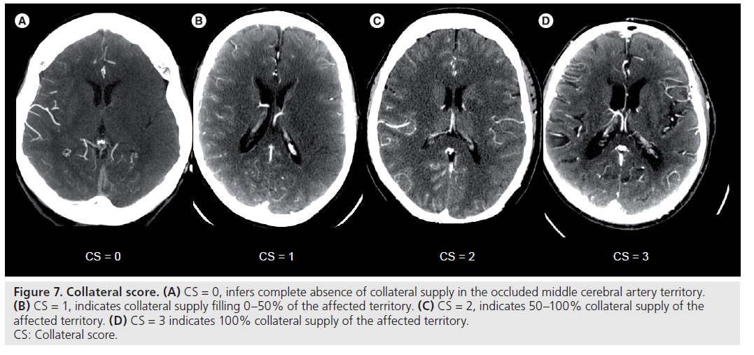 imaging-in-medicine-Collateral-score