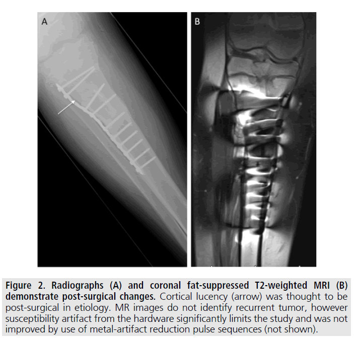 imaging-in-medicine-Cortical-lucency