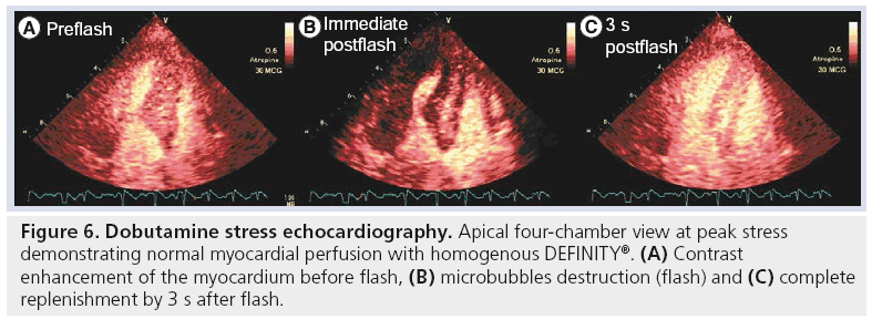 imaging-in-medicine-Dobutamine-stress