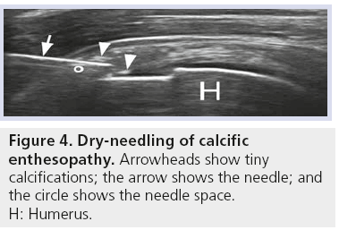 imaging-in-medicine-Dry-needling