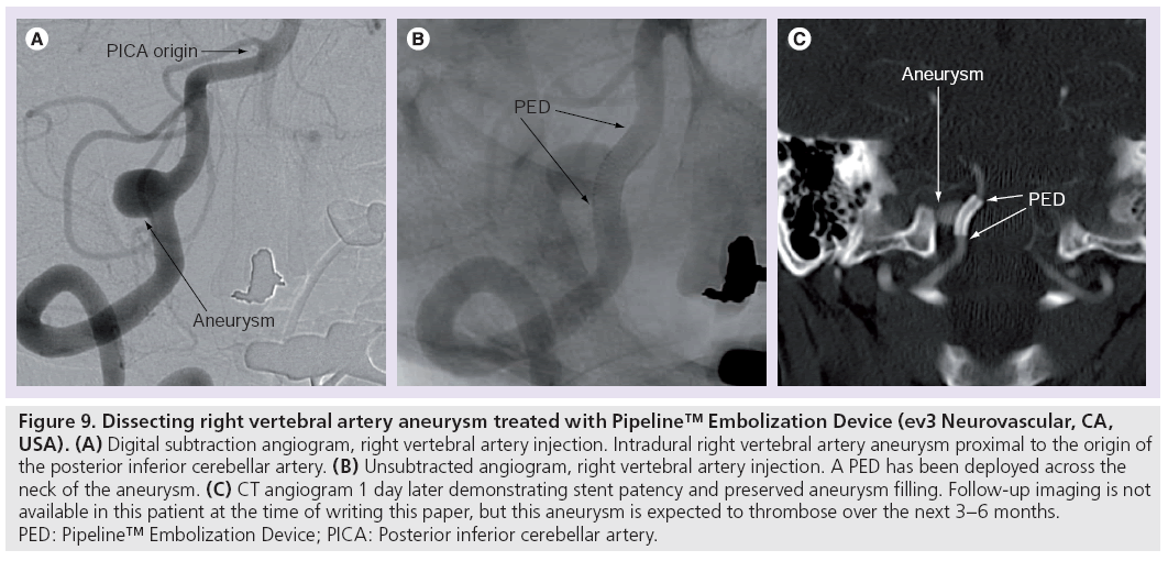 imaging-in-medicine-Embolization-Device