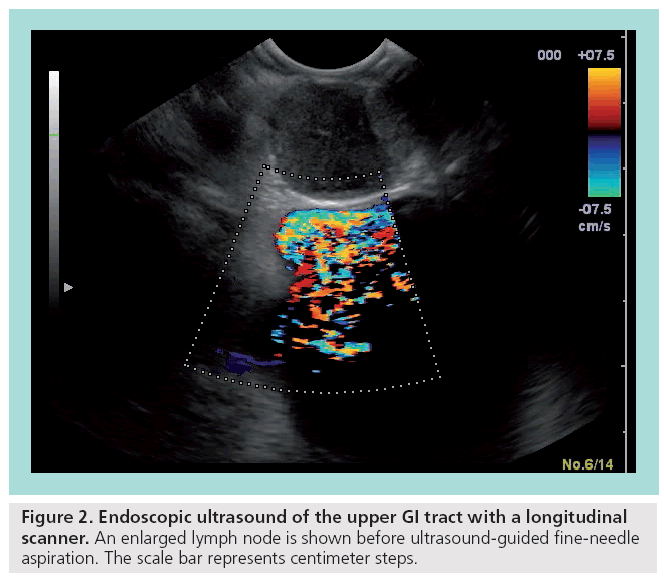 imaging-in-medicine-Endoscopic-ultrasound