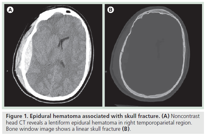 imaging-in-medicine-Epidural-hematoma