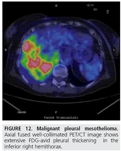 imaging-in-medicine-FDG-avid