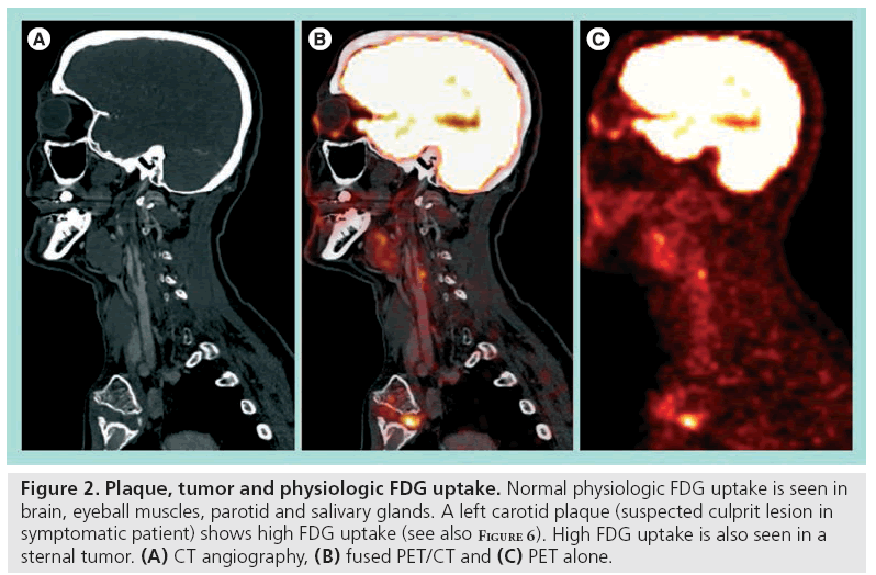 imaging-in-medicine-FDG-uptake