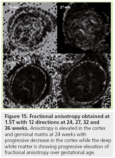 imaging-in-medicine-Fractional-anisotropy