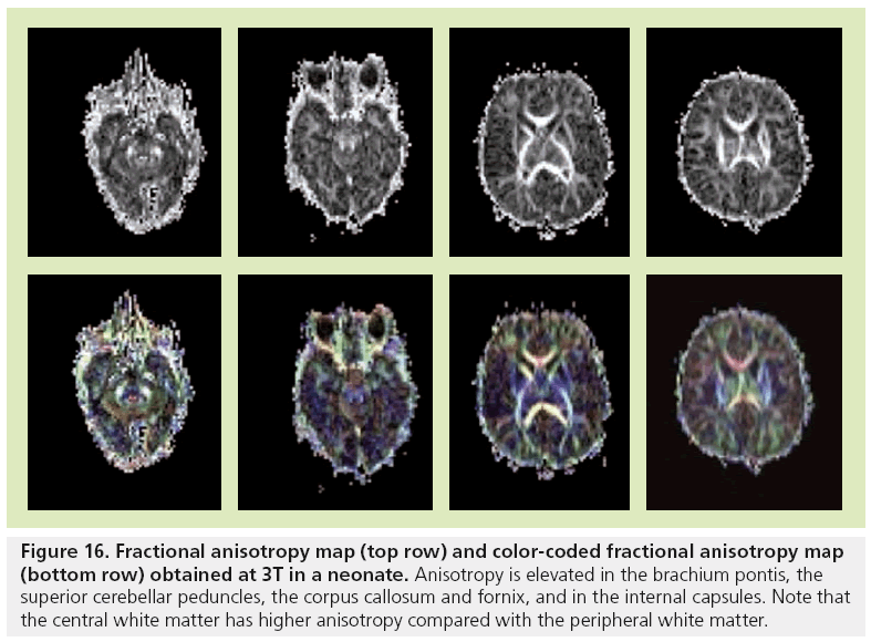 imaging-in-medicine-Fractional-anisotropy