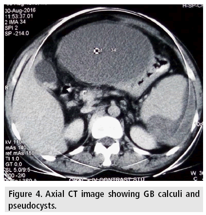 imaging-in-medicine-GB-calculi