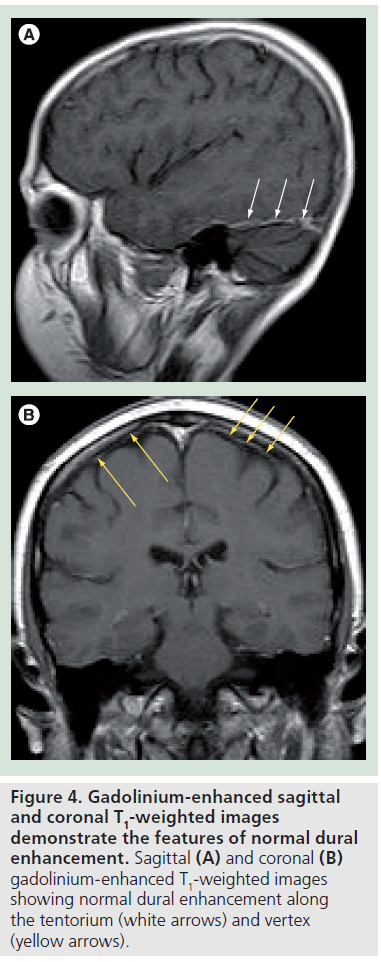 imaging-in-medicine-Gadolinium-enhanced