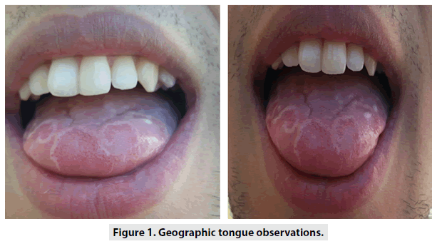 imaging-in-medicine-Geographic-tongue