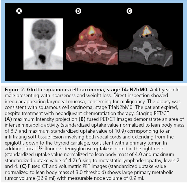 imaging-in-medicine-Glottic-squamous