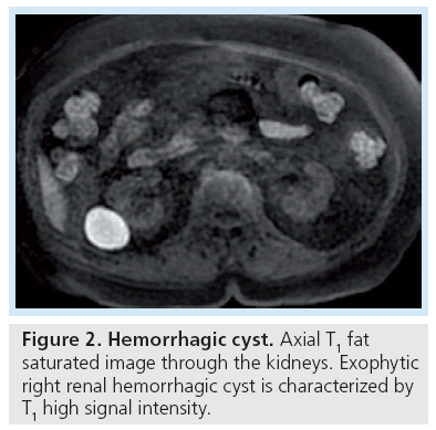 imaging-in-medicine-Hemorrhagic-cyst