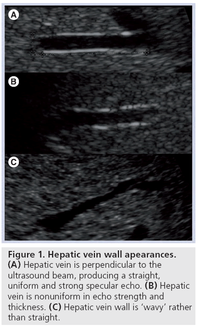 imaging-in-medicine-Hepatic-vein