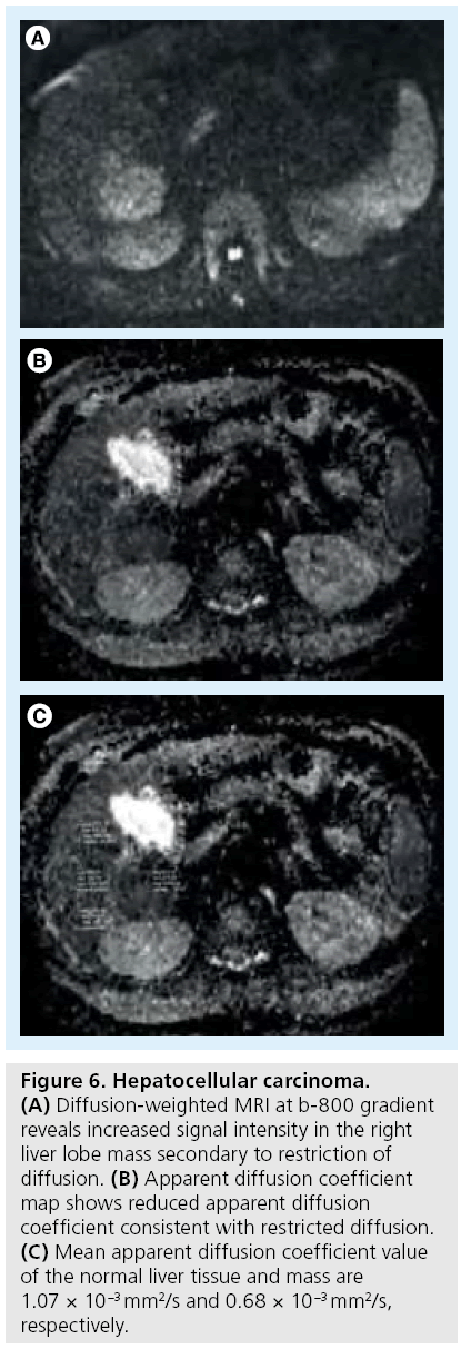 imaging-in-medicine-Hepatocellular