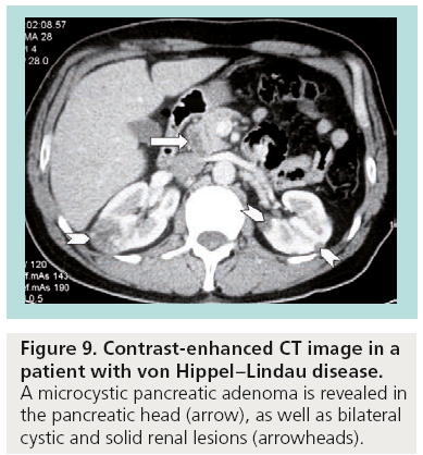 imaging-in-medicine-Hippel–Lindau