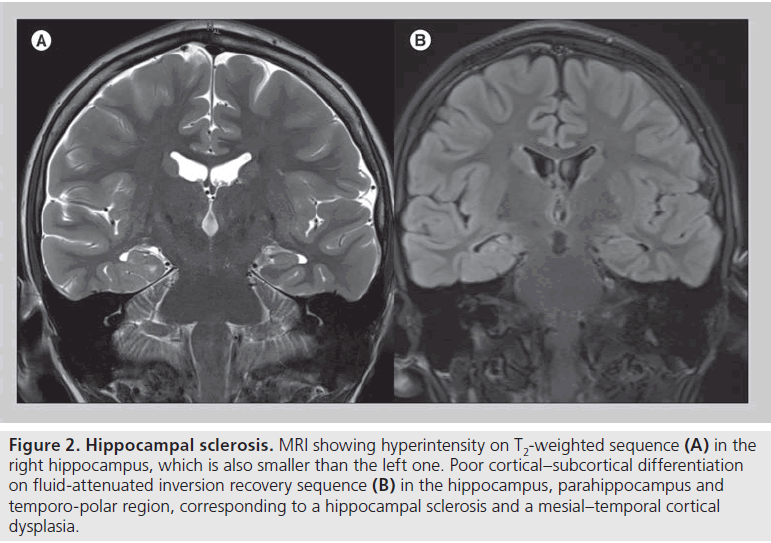 imaging-in-medicine-Hippocampal-sclerosis