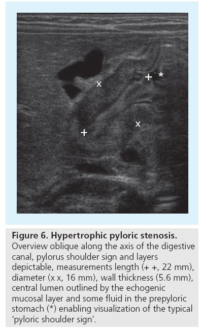 imaging-in-medicine-Hypertrophic-pyloric