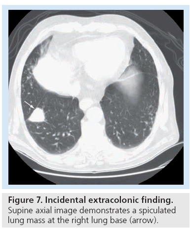 imaging-in-medicine-Incidental-extracolonic