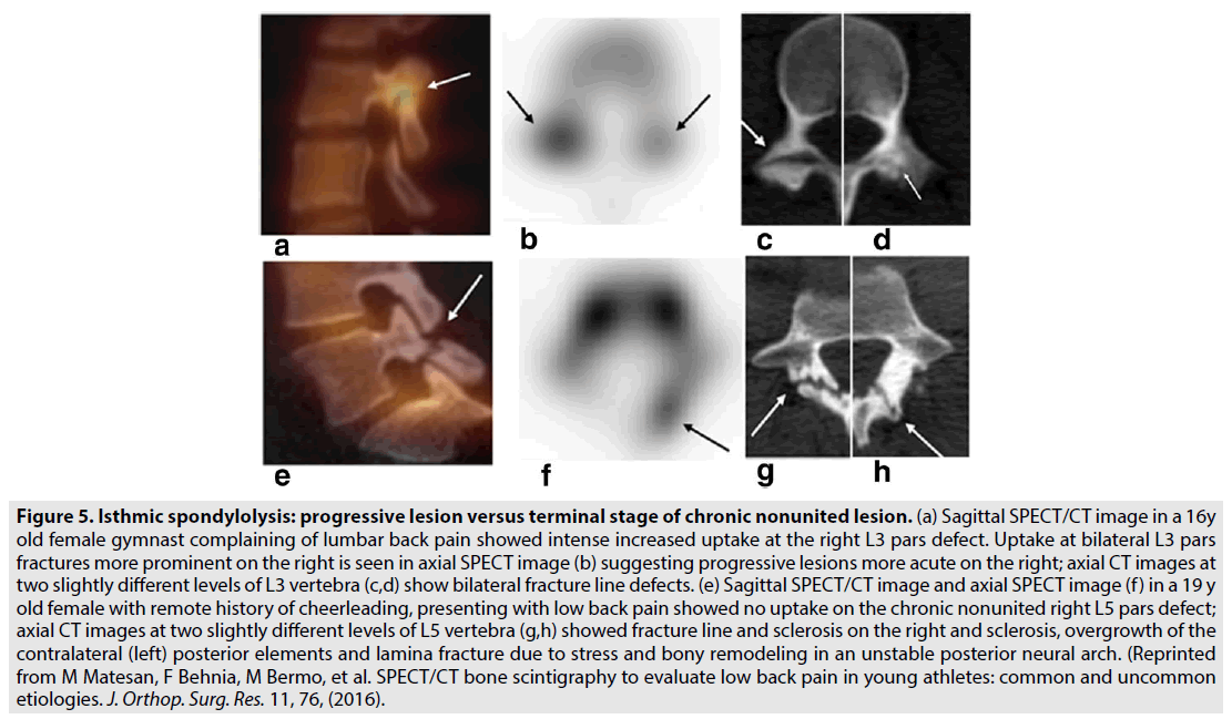 imaging-in-medicine-Isthmic-spondylolysis