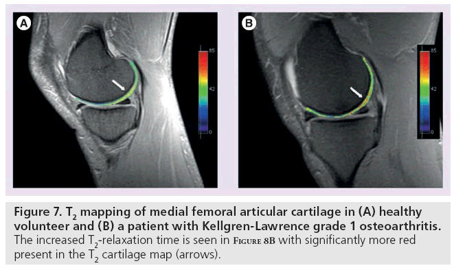 imaging-in-medicine-Kellgren-Lawrence