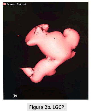 imaging-in-medicine-LGCP