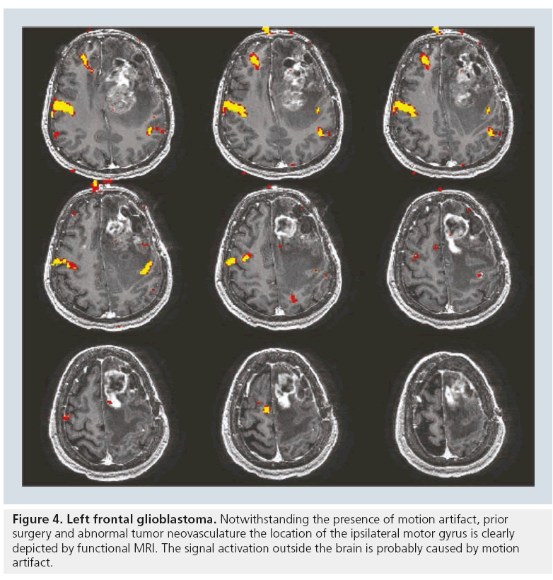 imaging-in-medicine-Left-frontal