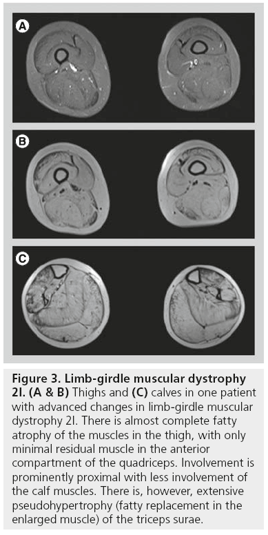 imaging-in-medicine-Limb-girdle