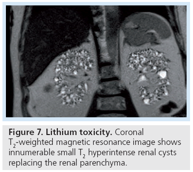 imaging-in-medicine-Lithium-toxicity