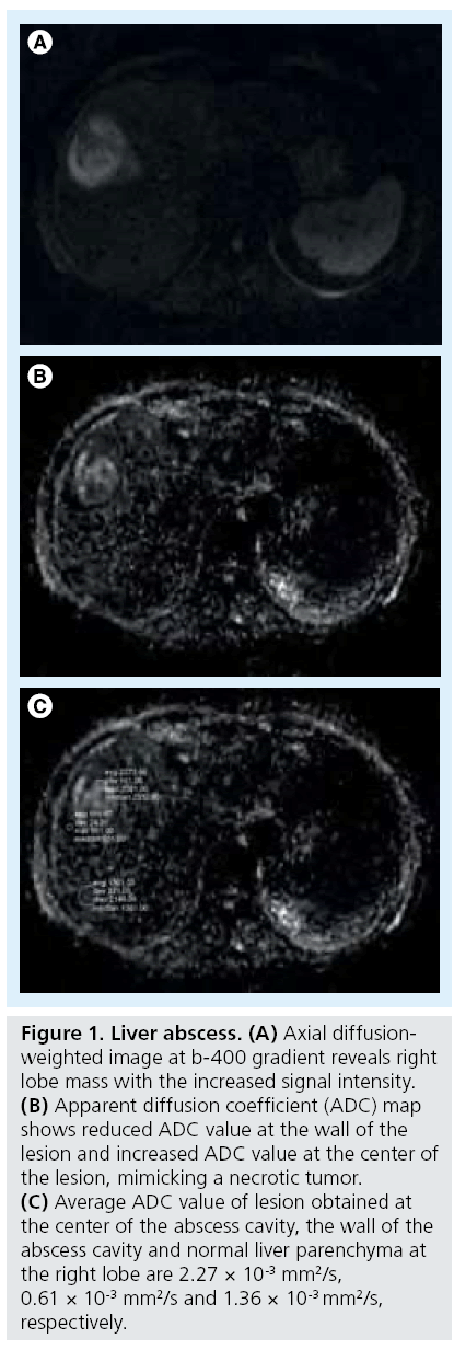 imaging-in-medicine-Liver-abscess